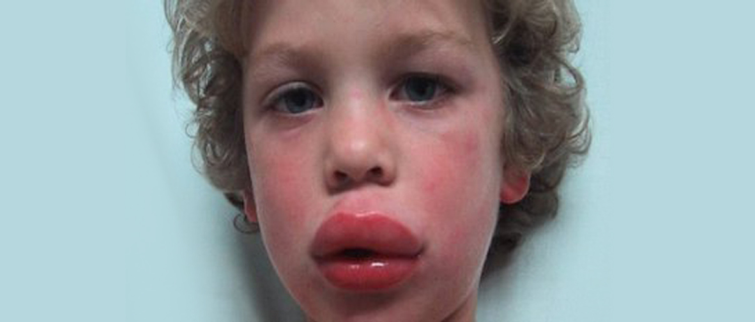 home allergic child